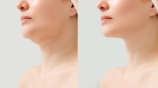 How to Get Rid of Double Chin Effectively