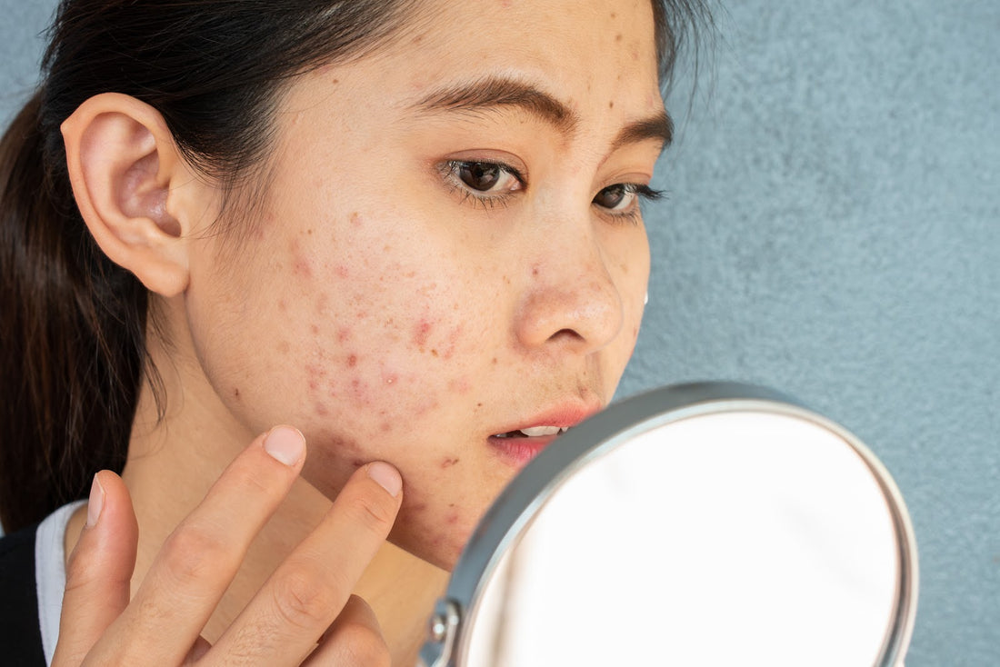 Acne scars are a common facial concern everyone faces and require the right skincare products to treat it.